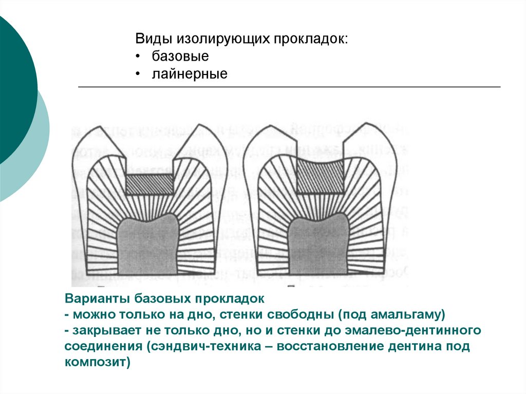 Варианты базового. Лайнерная изолирующая прокладка. Изолирующая прокладка под композитный материал схема. Изолирующая прокладка схема. Базовая прокладка в стоматологии.