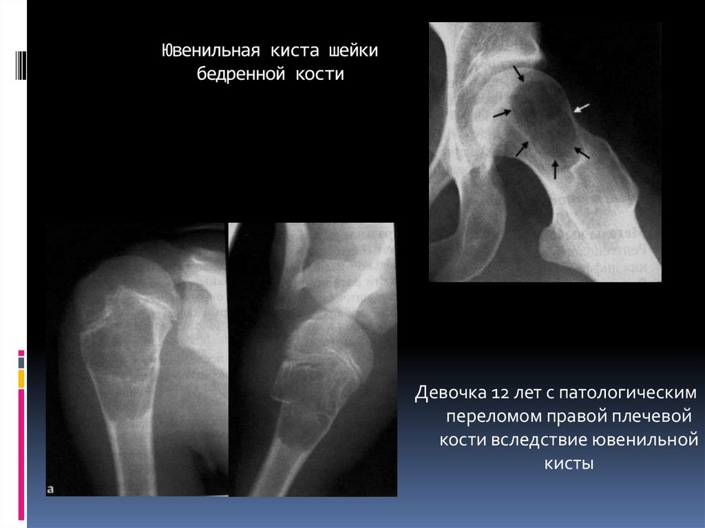 Операция кисты кости. Солитарная киста бедренной кости рентген. Аневризмальная киста малоберцовой кости. Костная киста плечевой кости. Аневризмальная киста бедренной кости рентген.