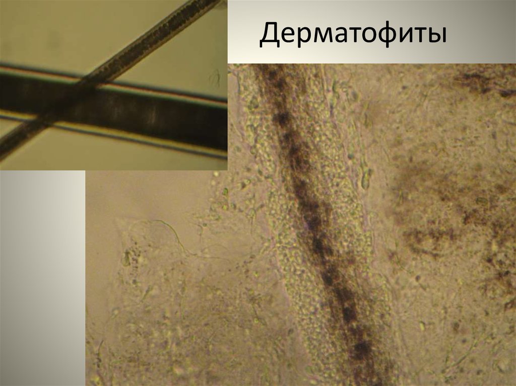 Соскоб кожи мицелий. Дерматофиты микроскопия. Нити мицелия микроскопия.