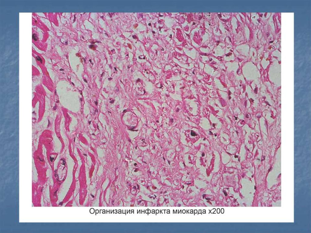 Кардиосклероз рисунок микропрепарат