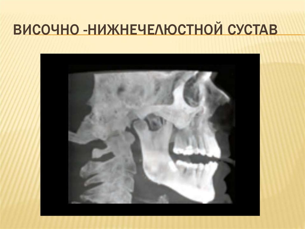 Внчс. Рентген височно-нижнечелюстного сустава. Височно-нижнечелюстной сустав рентген анатомия. Рентген нижнечелюстного сустава укладка. Височно челюстной сустав рентген.