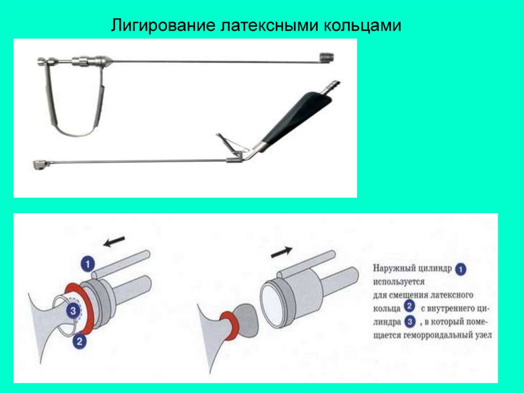 Лигирование латексными кольцами фото