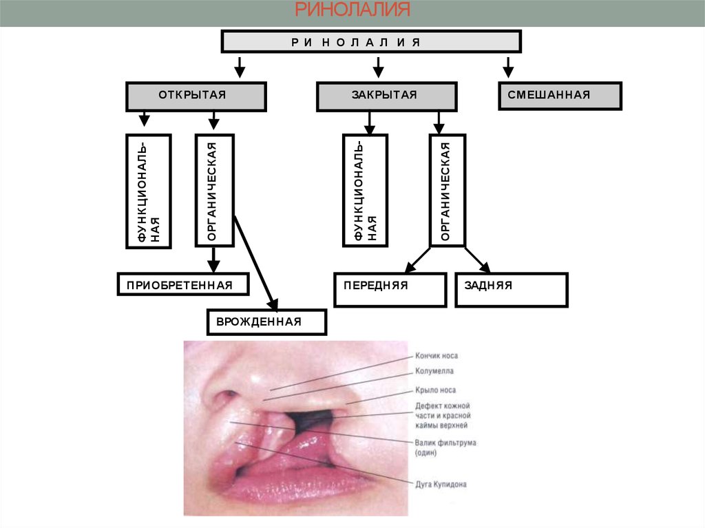 Виды расщелин губы и неба при ринолалии схема