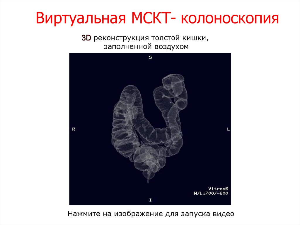 Кт колоноскопия. Виртуальная колоноскопия на МСКТ. Виртуальная кт колоноскопия. МСКТ С виртуальной колоноскопией.