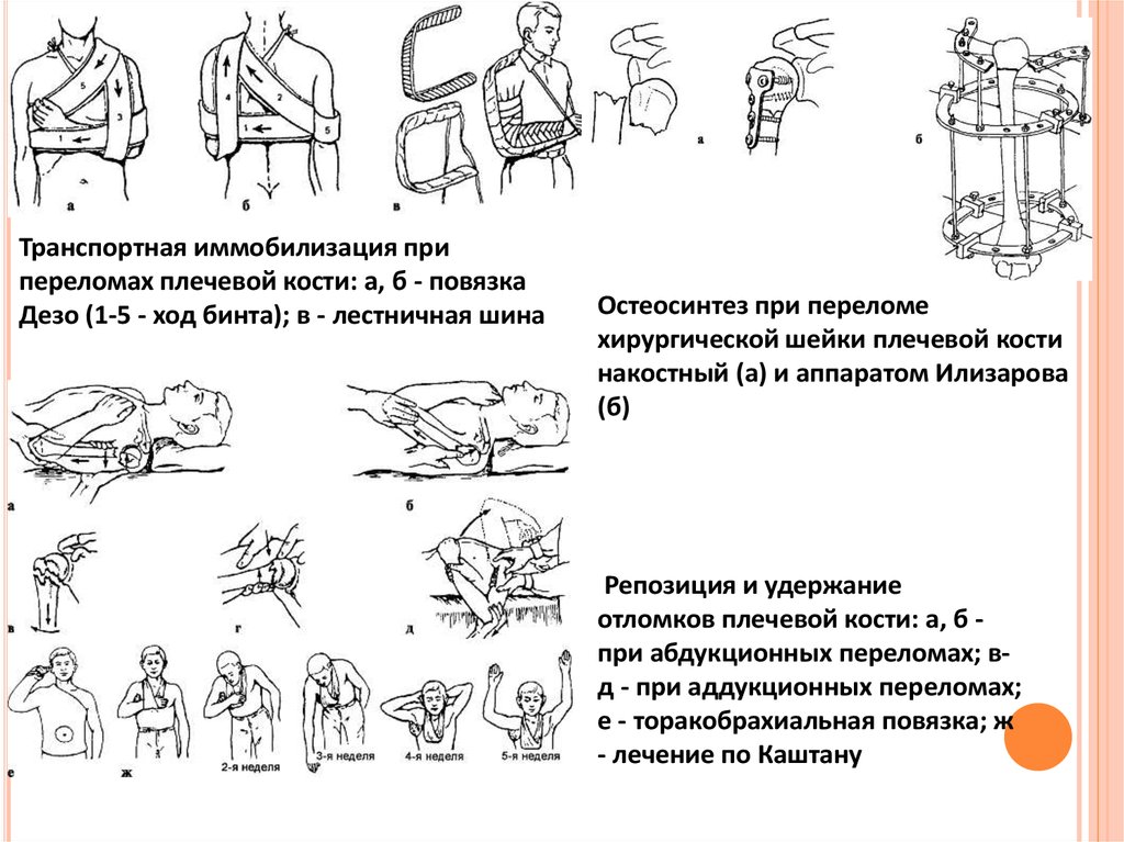 Лфк при переломах. Упражнения при переломе плечевой кости. Иммобилизация конечности при переломе головки лучевой кости. ЛФК при переломе плечевой кости. Комплекс ЛФК при переломе плечевой кости.