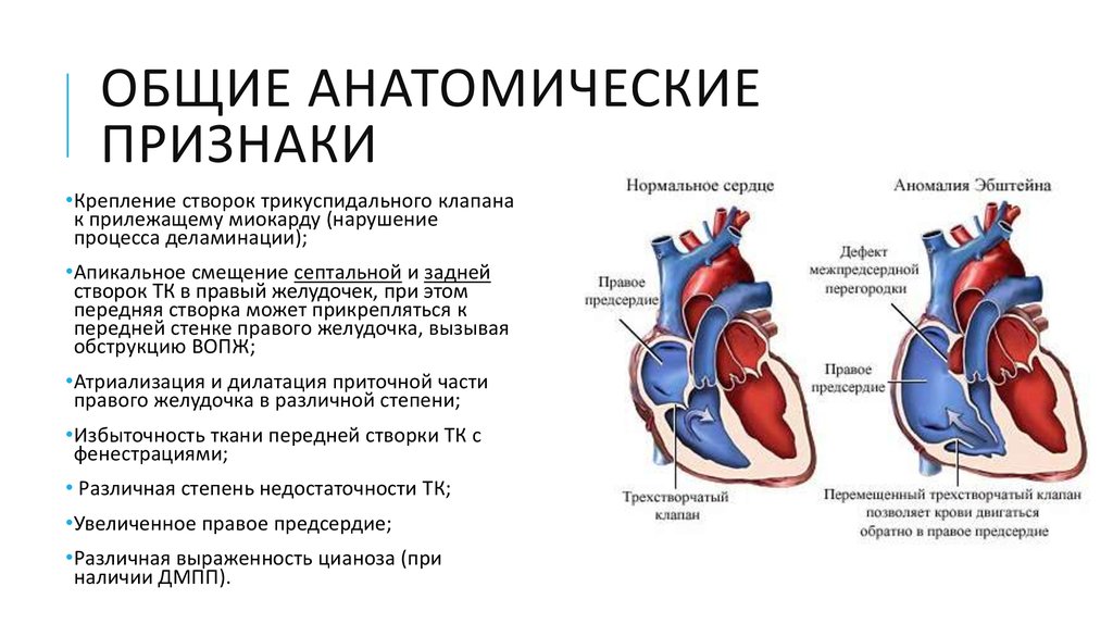 Недостаточность предсердия. Аномалия Эбштейна гемодинамика. Аномалия Эбштейна сердца клинические рекомендации. Врождённый порок сердца трикуспидальный клапан. Врожденный порок сердца Эпштейна.