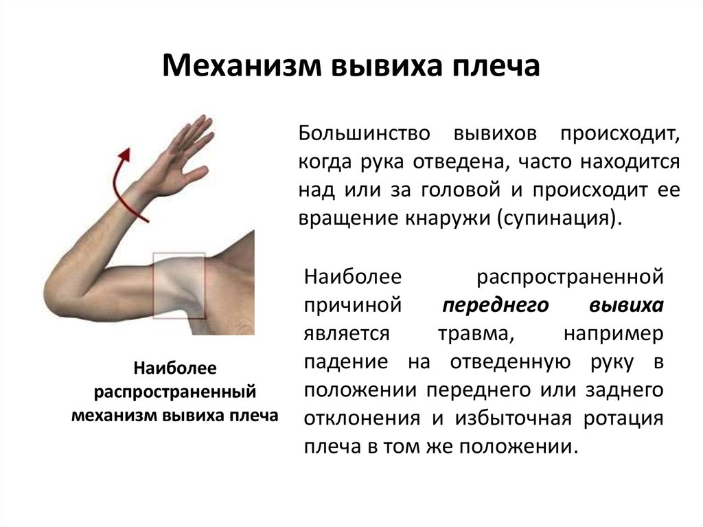 Что делать если поднимают руку. Механизм повреждения плечевого сустава. Вывих плеча механизм травмы. Механизм травмы при вывихе плеча.