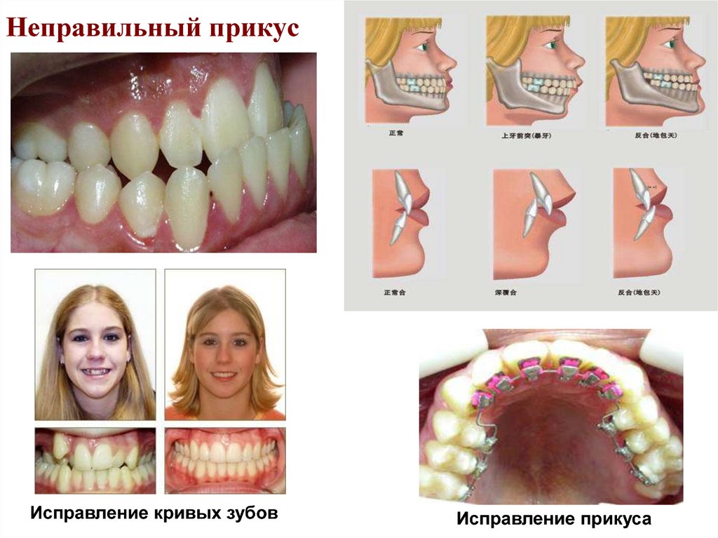 Правильный прикус у человека схема как определить фото