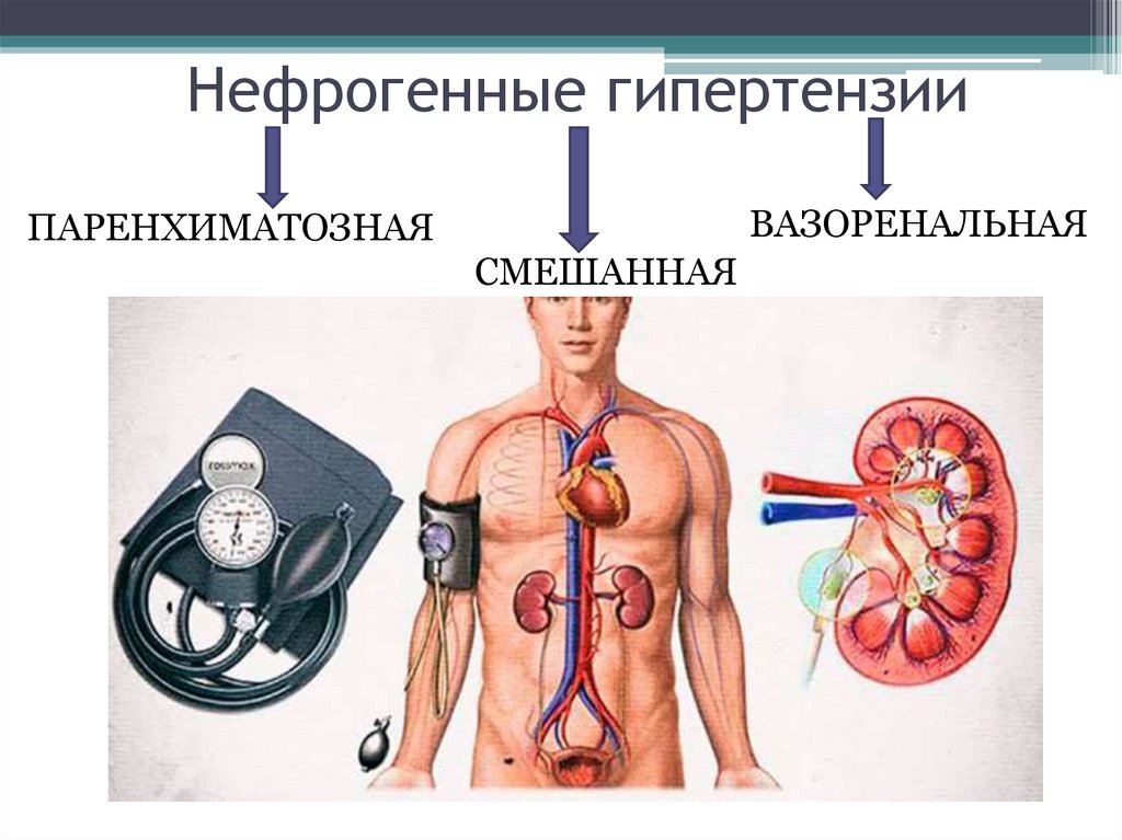 Синдром артериальной гипертензии. Синдром почечной артериальной гипертензии. Нефрогенной артериальной гипертензии. Нефрогенная артериальная гипертензия. Неырооенная артериальная гипертензия.