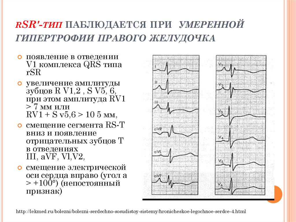 Что такое гипертрофия левого желудочка