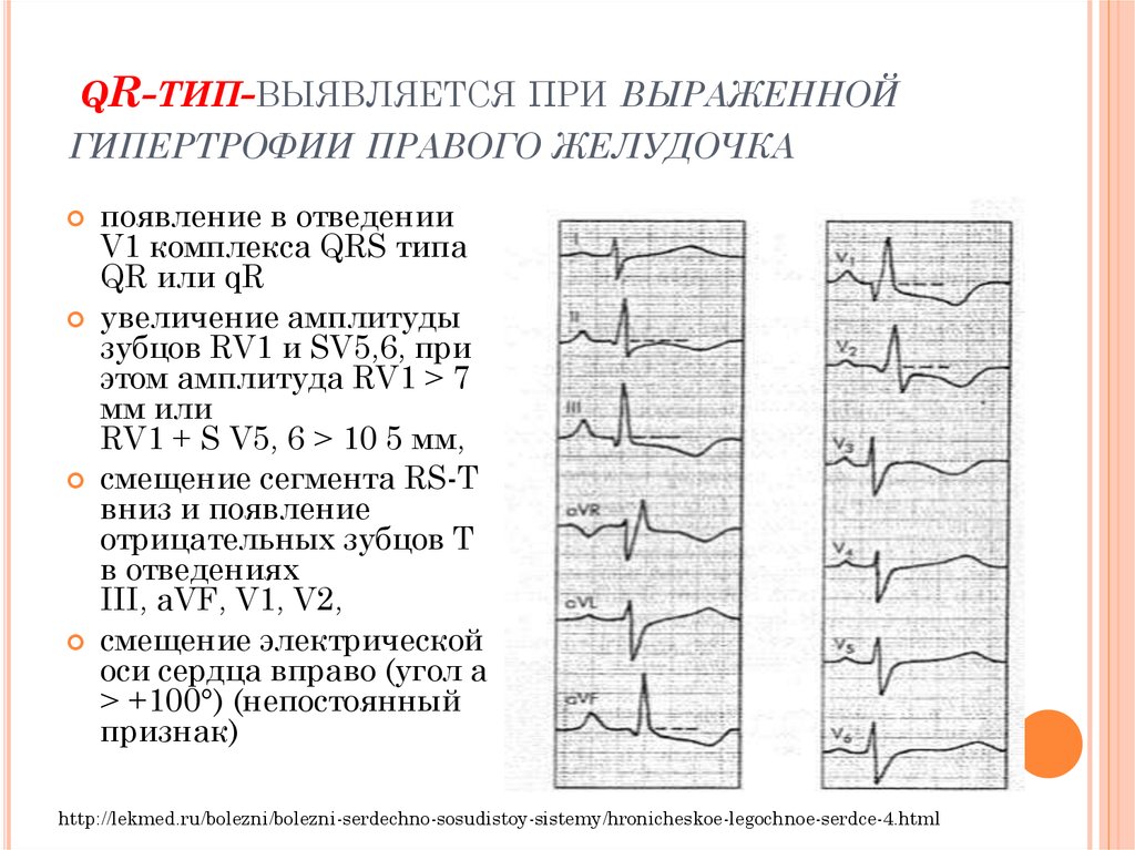 Типы экг