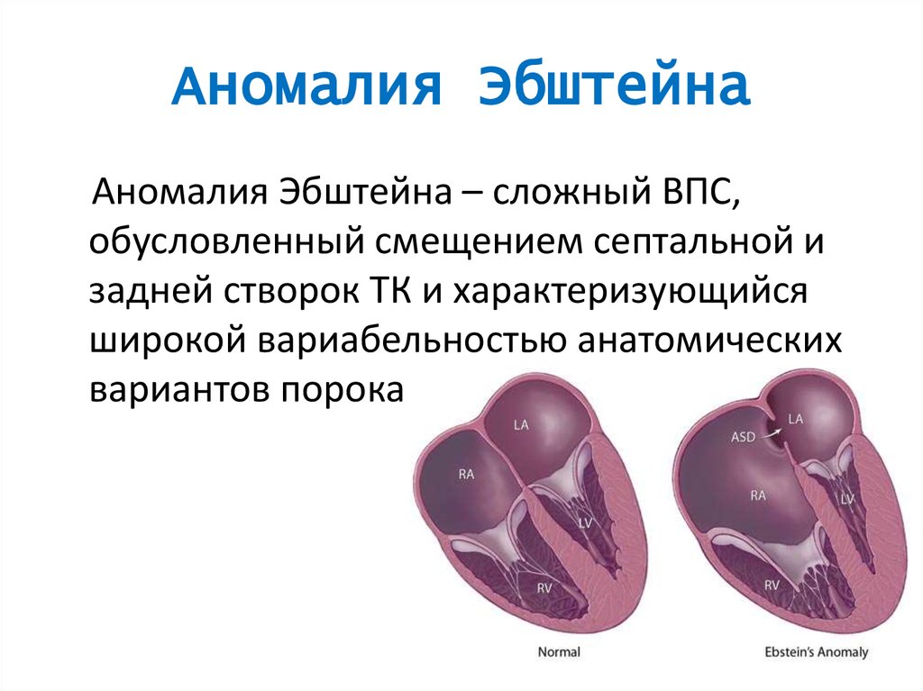 Аномалия эбштейна фото