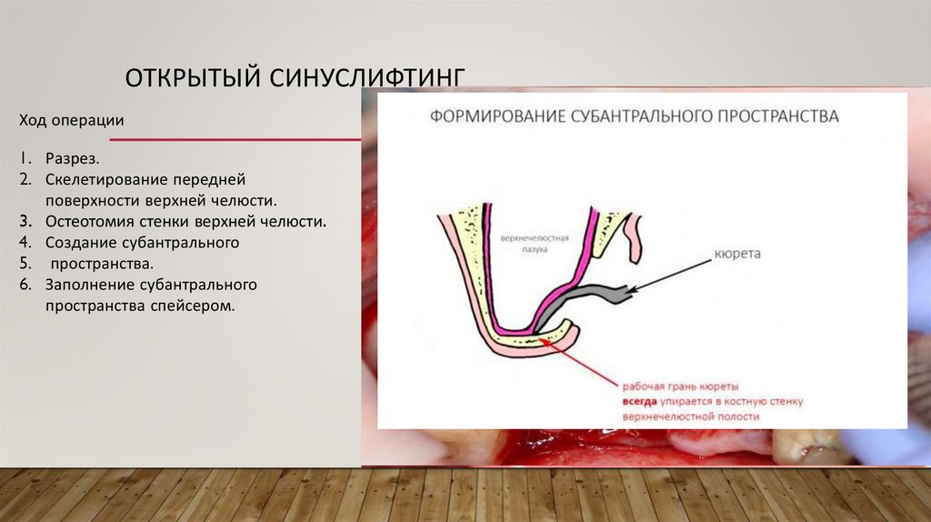 Синус операции. Открытый синус лифтинг показания. Синус лифтинг презентация. Операция открытого синуслифтинга. Показания к проведению синус лифтинга.