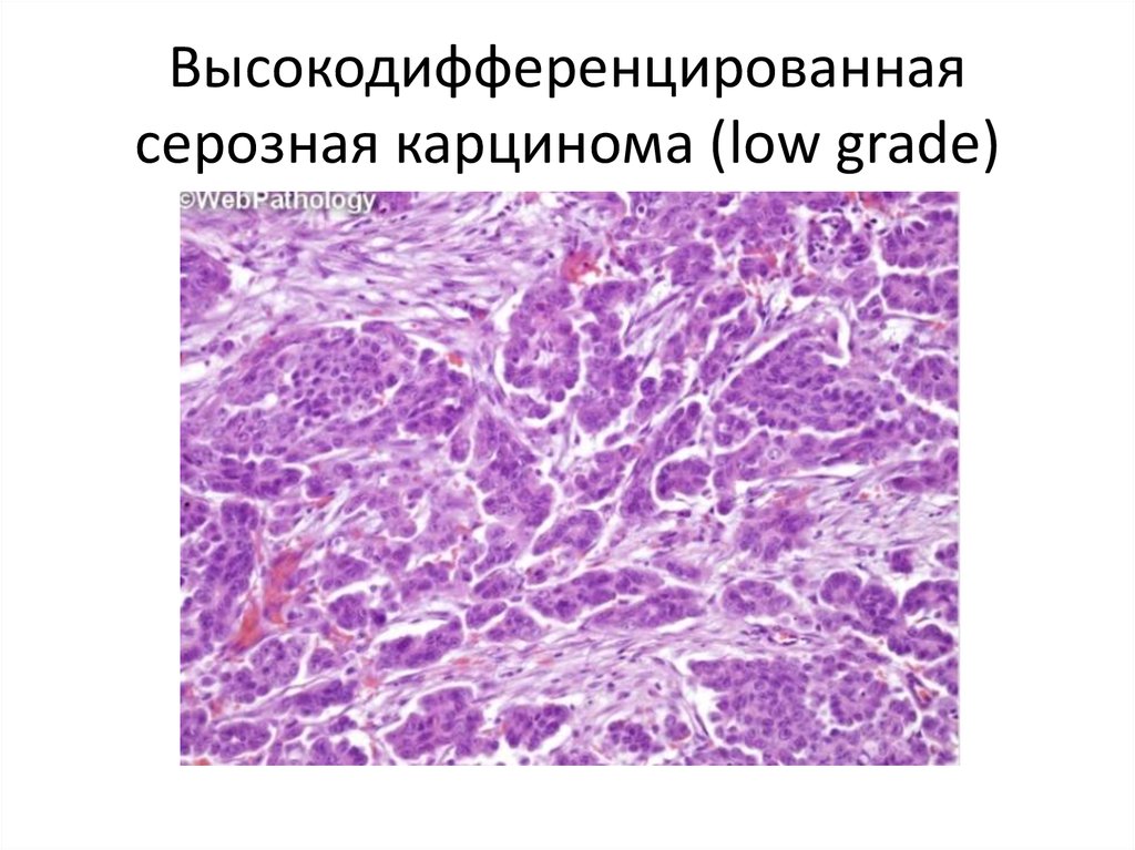 Эндометриоидная аденокарцинома яичника