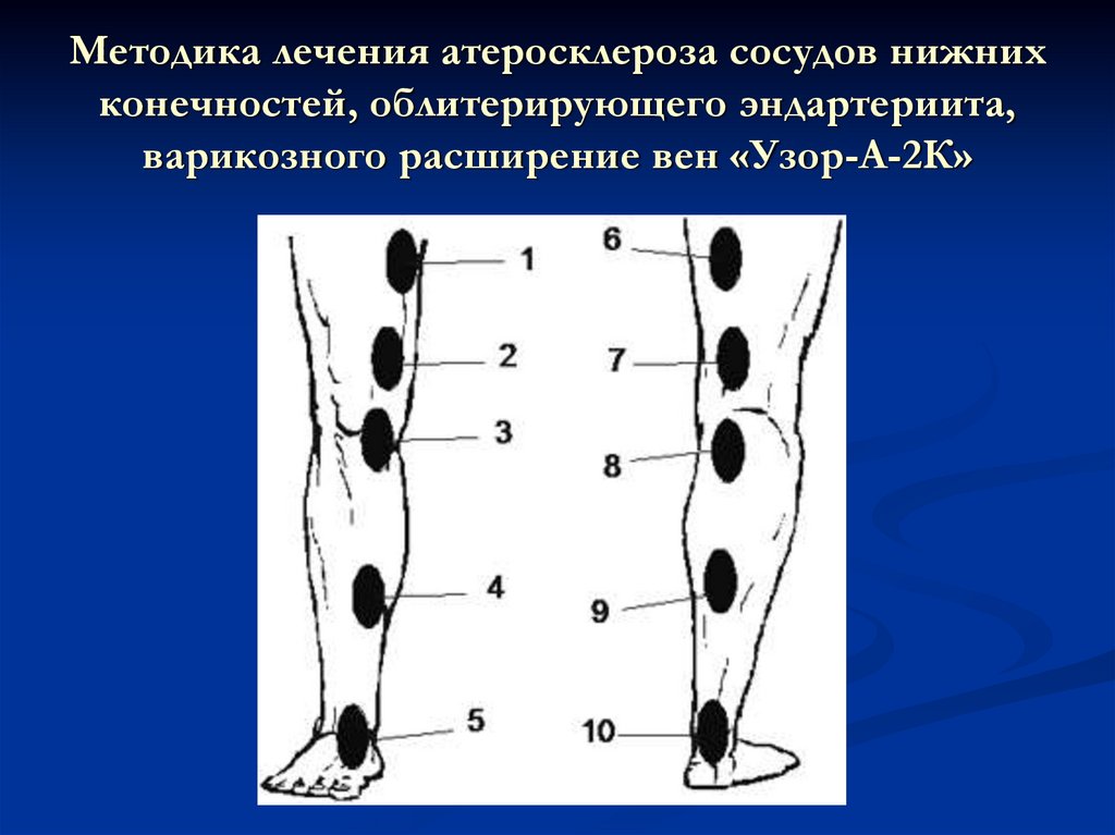 Атеросклероз ноги лечить