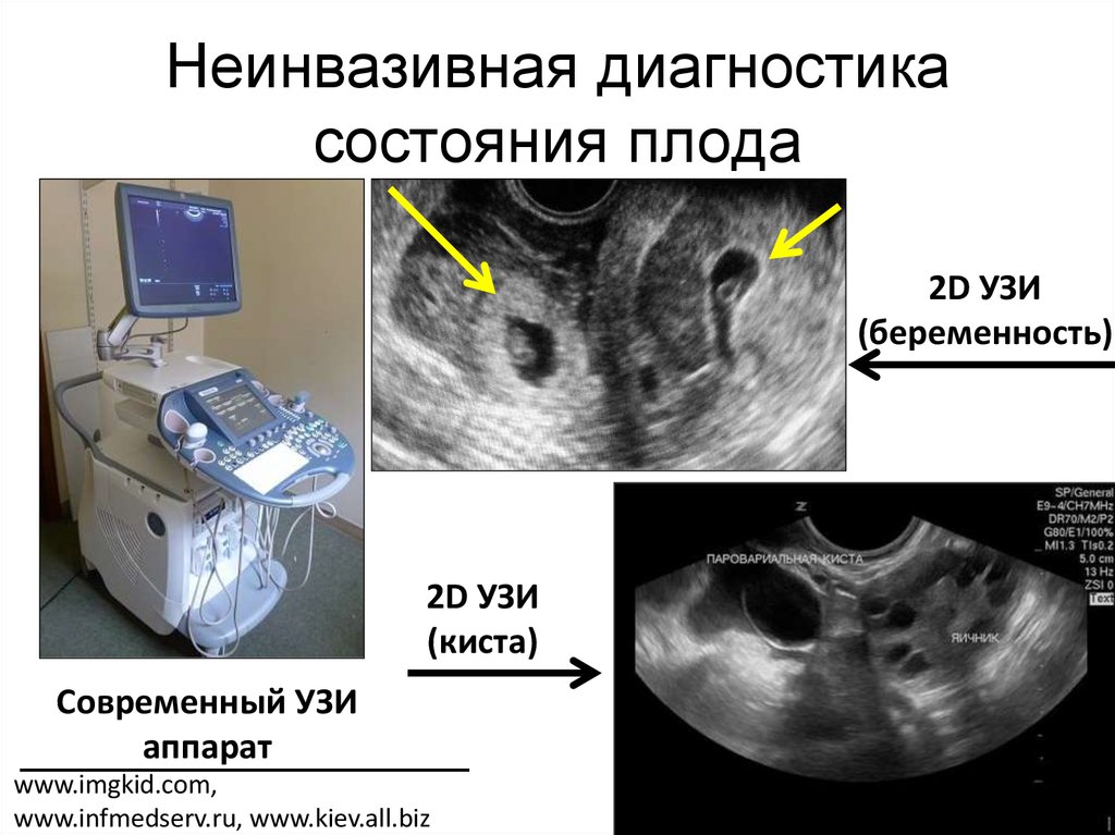 Инвазивный и неинвазивный. Неинвазивные методы УЗИ. Неинвазивные методы дородовой диагностики. Неинвазивные методы диагностики состояния плода. Методы пренатальной диагностики УЗИ.