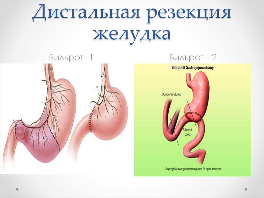 Операция резекция желудка