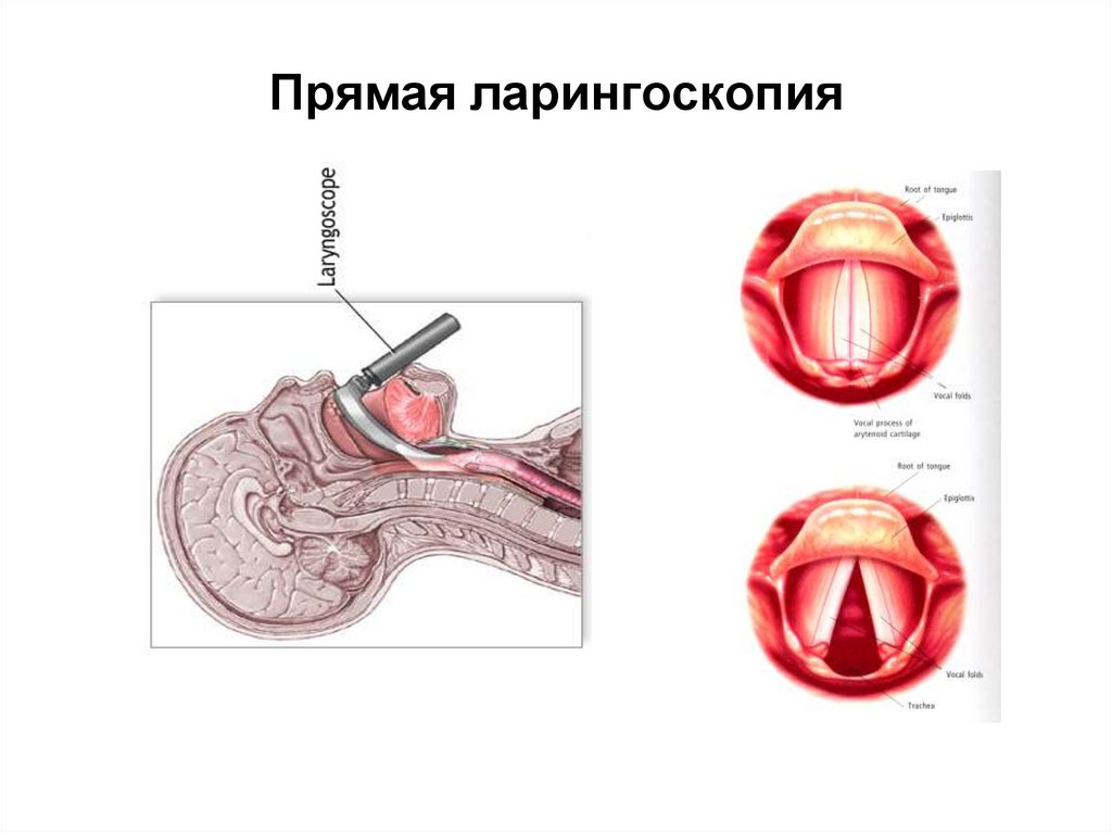 Стридор у детей