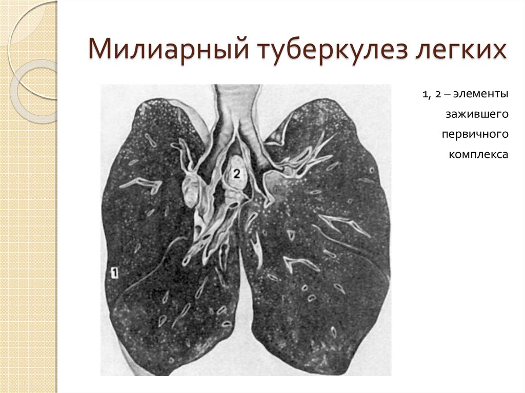 Туберкулез легких. Острый милиарный туберкулез. Милиарный туберкулез острый кт. Милиарный туберкулез фтизиатрия. Хронический милиарный туберкулез это.