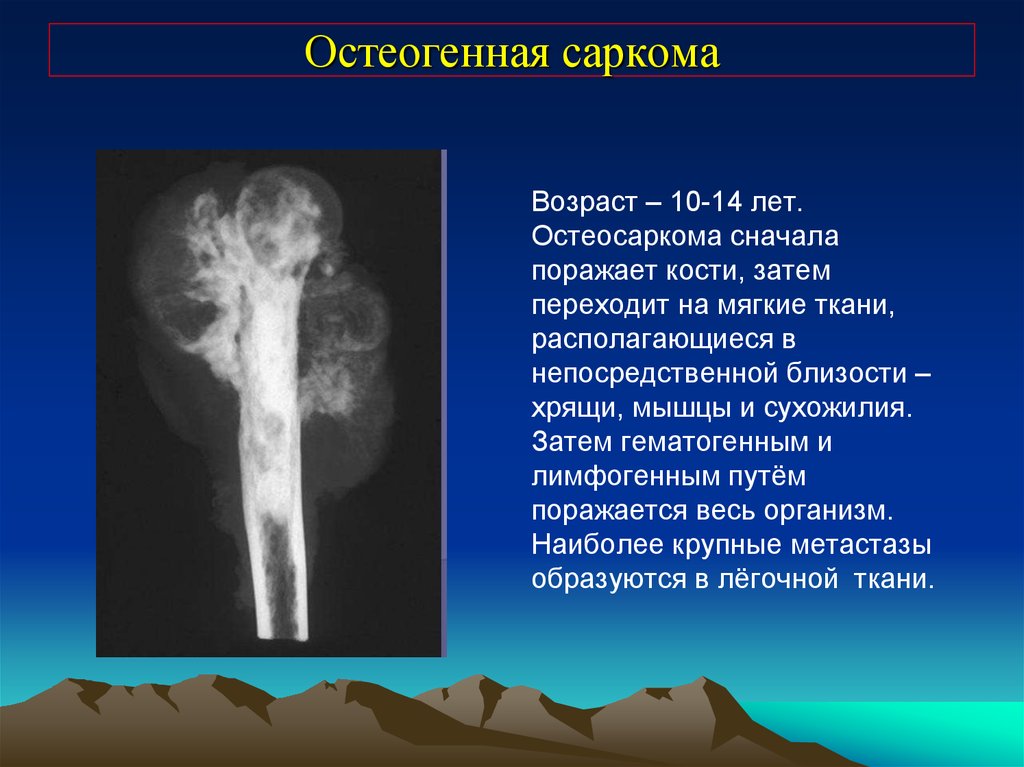 Чем отличается саркома. Саркомы костей рентген. Остеосаркома бедренной кости. Остеосаркома (остеогенная саркома).