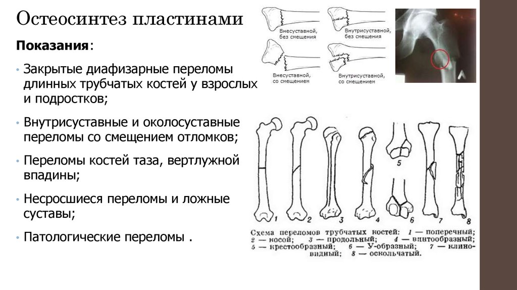 Закрытый перелом нижней трети голени карта вызова