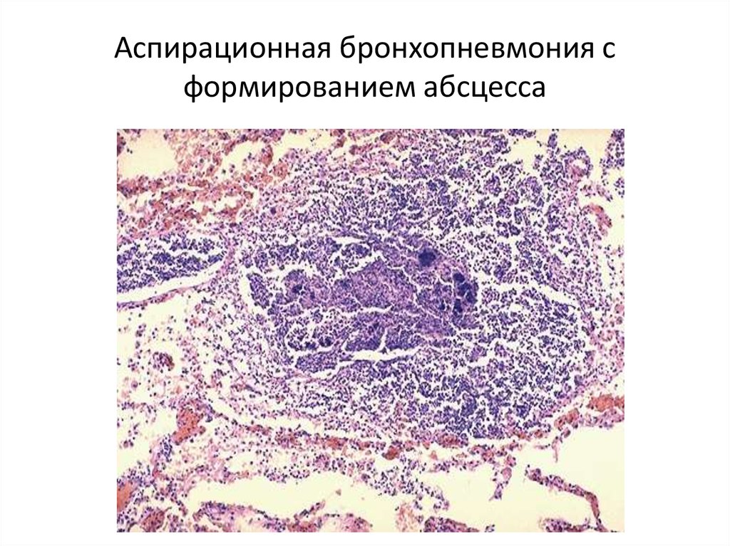 Аспирационная пневмония. Аспирационная пневмония микропрепарат. Абсцедирующая пневмония микропрепарат. Очаговая пневмония бронхопневмония микропрепарат. Аспирационная пневмония новорожденных патанатомия.