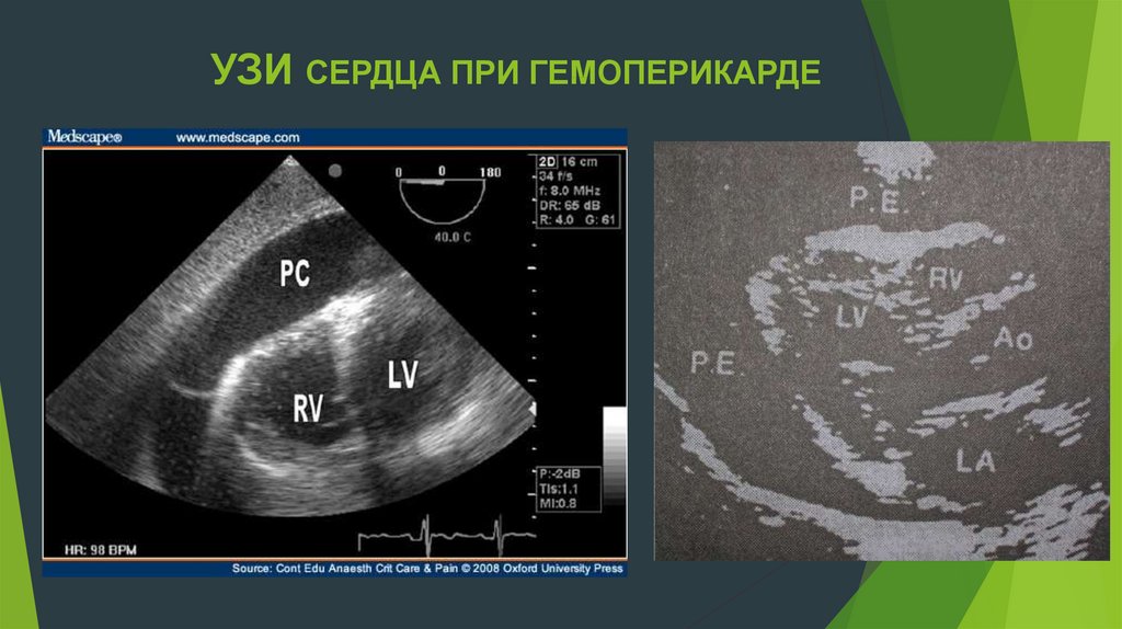 Адрес узи сердца. Тампонада сердца на ЭХОКГ. Тампонада сердца УЗИ. Жидкость в перикарде на ЭХОКГ.