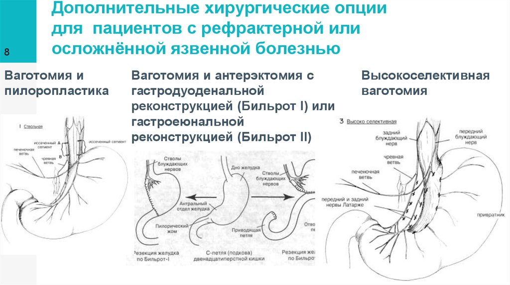 Резекция желудка по витебскому схема операции