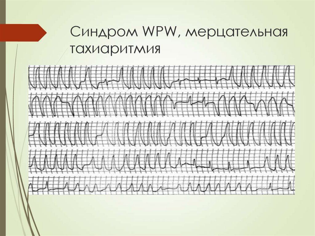 Синдром впв презентация