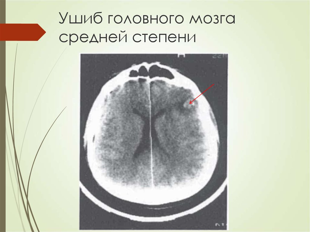 Ушиб головного мозга. Ушиб головного мозга средней степени. Ушиб головного мозга средней степени тяжести кт. Ушиб головного мозга кт степени. Ушиб головного мозга первой степени.