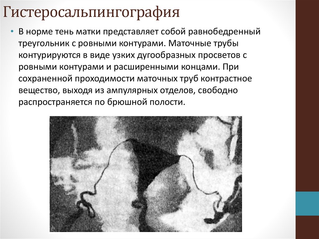 Повышенный проходимы. Гистеросальпингография описание метода. Гистеросальпингография норма. Гистеросальпингография рентген описание. Гистеросальпингография описание.