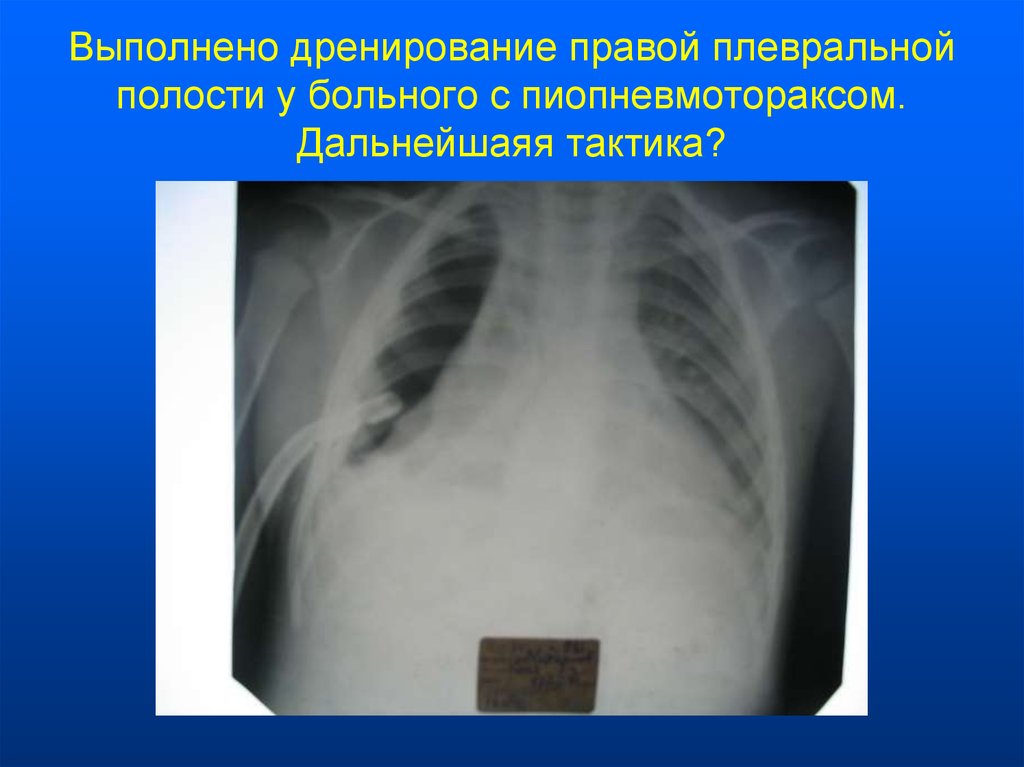 Полость страдать. Плевральное дренирование. Дренаж плевральной полости. Пассивное дренирование плевральной полости. Этапы дренирования плевральной полости при пневмотораксе.