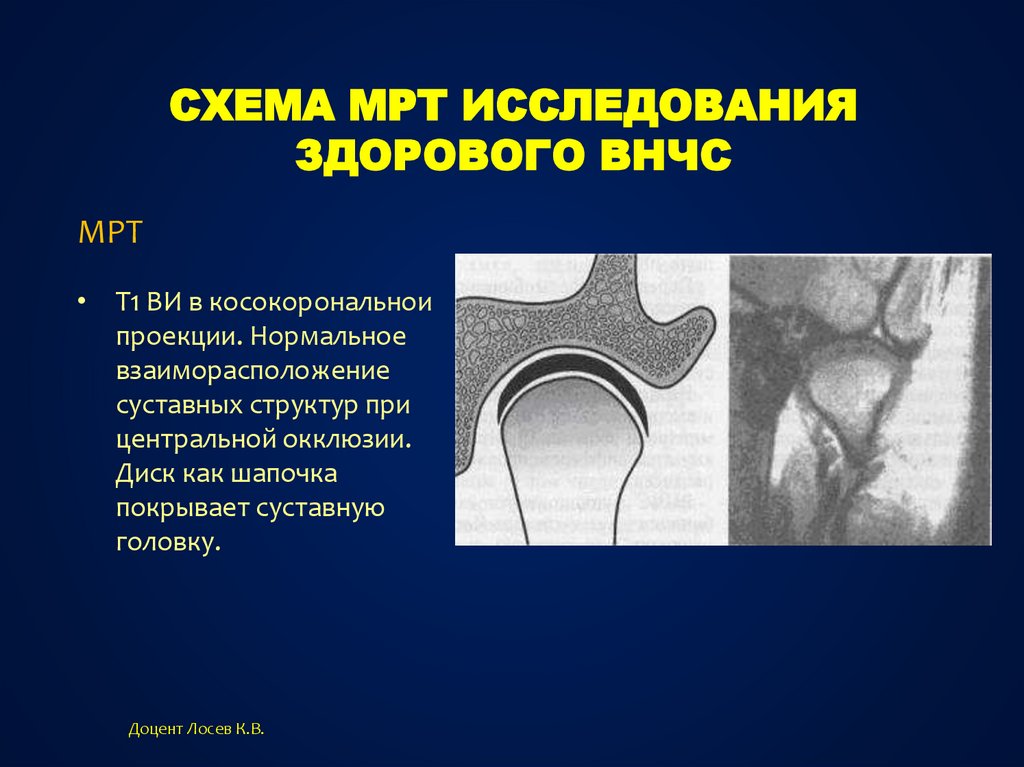 Мрт внчс. Суставной диск ВНЧС на мрт. Магнитно-резонансная томография артрит ВНЧС. Суставной диск височно-нижнечелюстного сустава мрт. Мрт височно-нижнечелюстного сустава протокол.