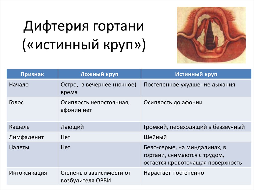 Ангина симптомы отличие от орви у взрослого без температуры фото