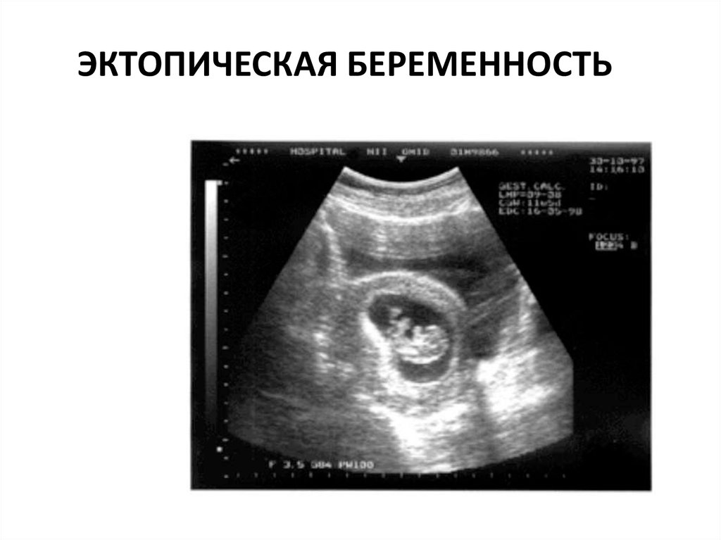 Риск внематочной беременности. Эктопическое расположение плодного яйца. Внематочная Трубная беременность. Внематочная беременность Трубная беременность. Внематочная (эктопическая) беременность.