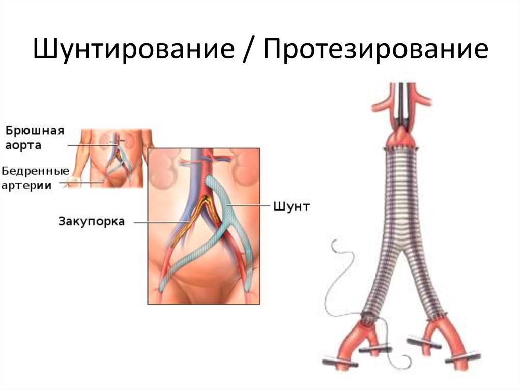 Операция на артерии нижних конечностей. Коронарное шунтирование сосудов сердца. Аортально коронарное шунтирование. Шунтирование аорты сердца. Шунтирование стентирование протезирование.