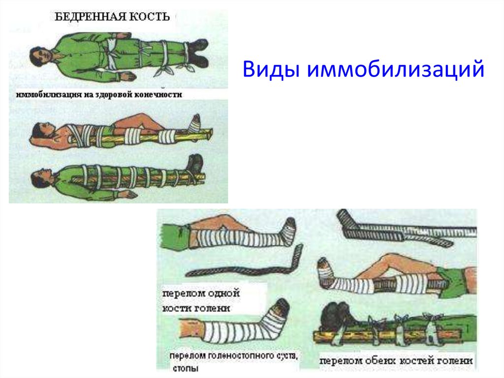 Иммобилизация при переломах костей