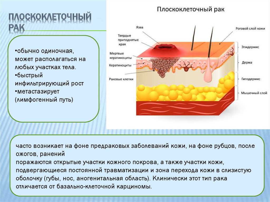 Очаг кожа. РПК кожи плоскоклеточный. Плоскоклеточнвй Раа кожи. Плоскокеточны йрак кожи. Раковые поражения кожи.