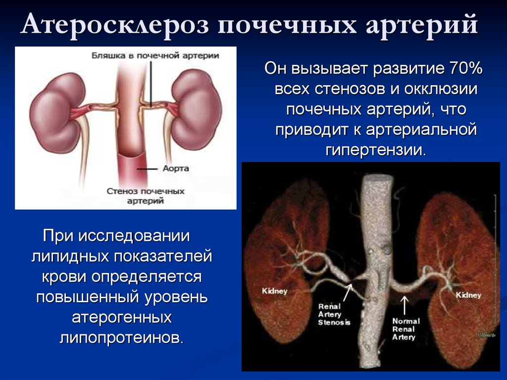 Изменение левой почки. Атеросклероз почечных артерий симптомы. Атеросклероз почечных артерий макропрепарат. Осложнения атеросклероза почечных артерий. Поражение почечной артерии атеросклерозом.