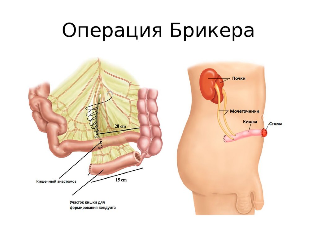 Операция мочевого. Цистэктомия операция Брикера. Илеокондуит по Брикеру. Операция Брикера уретероилеокутанеостомия что это. Кишечная пластика по Брикеру.