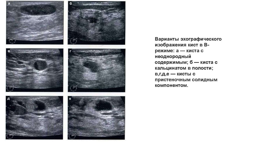 Что значит киста. Киста с кальцинатом в молочной железе на УЗИ. Кисты молочных желез с пристеночным солидным компонентом. Киста в яичника с пристеночным образованием.