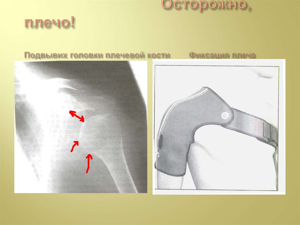 Головка плечевой кости. Подвывих головки плечевой кости. Подвывих плечевой кости рентген. Закрытый вывих головки плечевой кости.