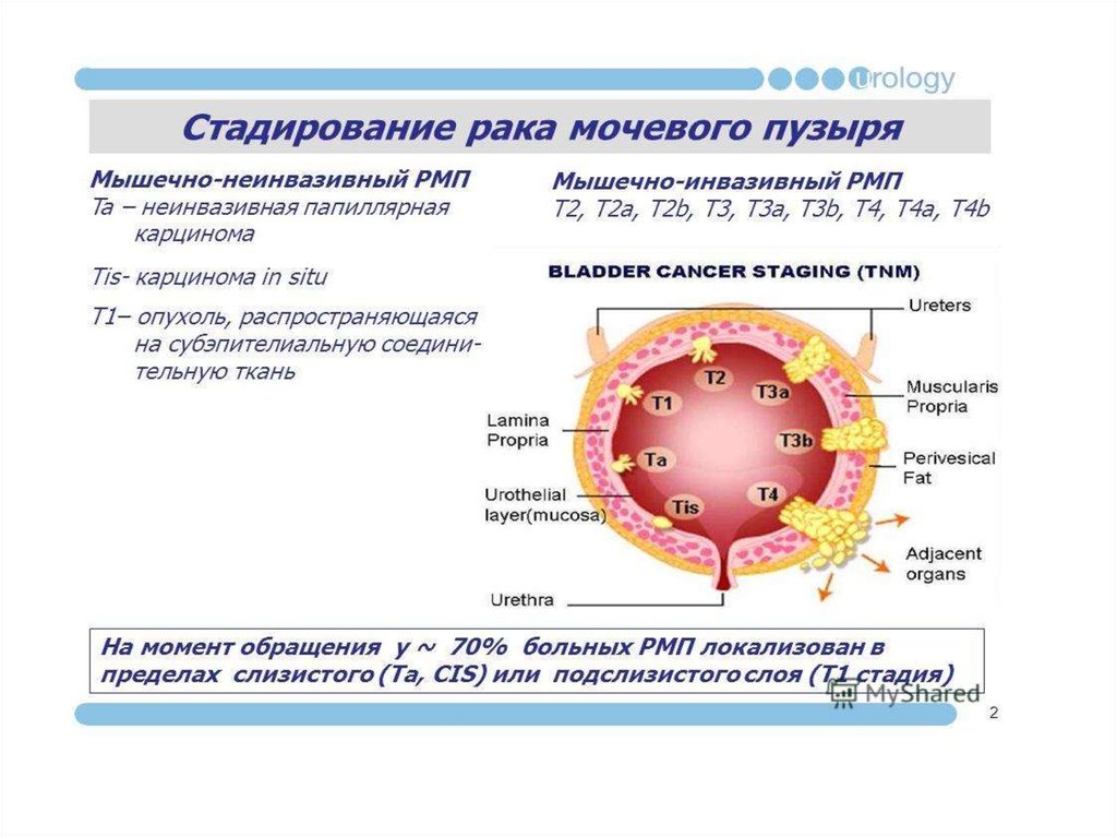 Рак мочевого 4 стадия. Опухоли мочевого пузыря этиология. Новообразования мочевого пузыря классификация. Стадии опухоли мочевого пузыря. Неинвазивная папиллярная карцинома.