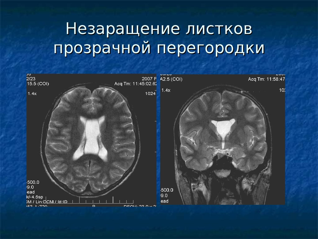 Прозрачная перегородка мозга. Незаращение прозрачной перегородки мозга мрт. Агенезия полости прозрачной перегородки. Незаращение листков прозрачной перегородки мрт. Агенезия прозрачной перегородки головного мозга на кт.