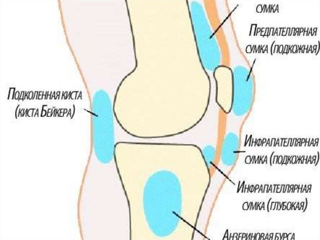 Какой врач лечит бурсит