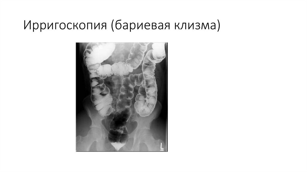 Ирригоскопия подготовка отзывы. Ирригоскопия Толстого кишечника. Ирригография методика проведения. Ирригоскопия осложнения. Рентгенологическое исследование Толстого кишечника (ирригоскопия)..