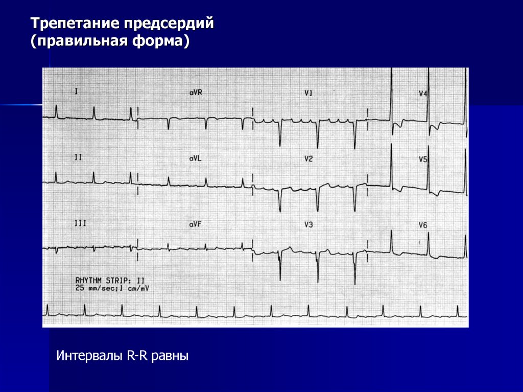 Трепетание предсердий карта вызова скорой медицинской помощи