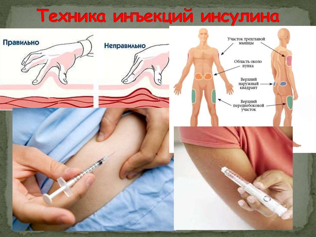 Подкожная инъекция алгоритм выполнения. Подкожная инъекция инсулина алгоритм. Алгоритм выполнения подкожной инъекции инсулина. Техника укола инсулина подкожно. Техника введения инсулина шприц ручкой алгоритм.