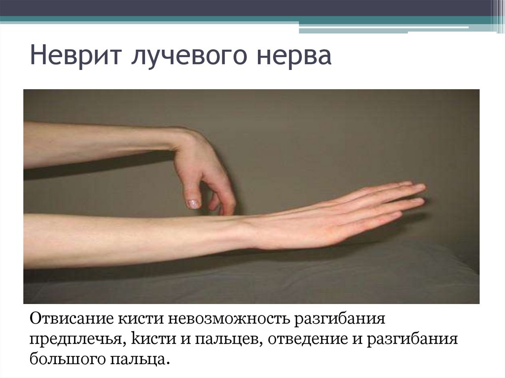 Поражение нервов руки. Невропатия локтевого и срединного нерва.