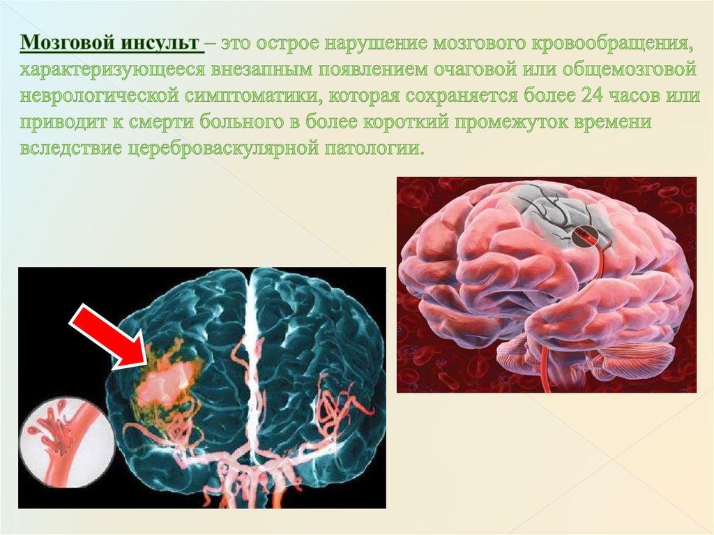 Нарушение мозгового кровообращения презентация